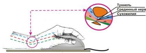 Карпальный туннельный синдром, карпальный канал